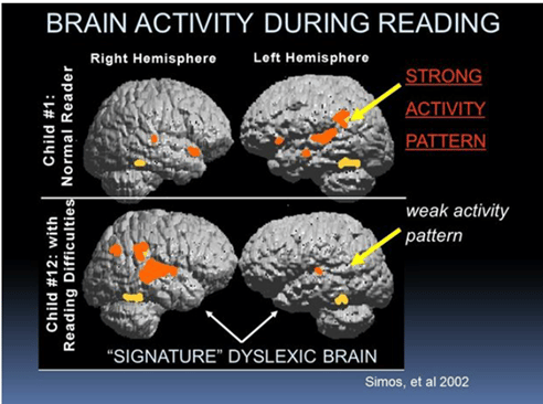 Side by side comparison of brain scans. Normal reader brain scans show strong activity pattern in the left hemisphere and then dyslexic brain scan shows a weak activity pattern in the left hemisphere. 